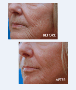 Ultimate Face Trio Procedure at Wallach Derma Center